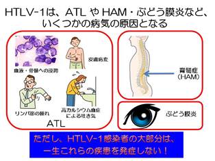 成人T細胞白血病リンパ腫（Adult T-cell Leukemia: ATL）-佐賀大学